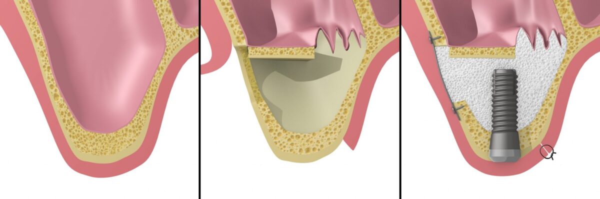 Sinus Lift What Is It And How Much Does It Cost Dental Clinic Crete 2617