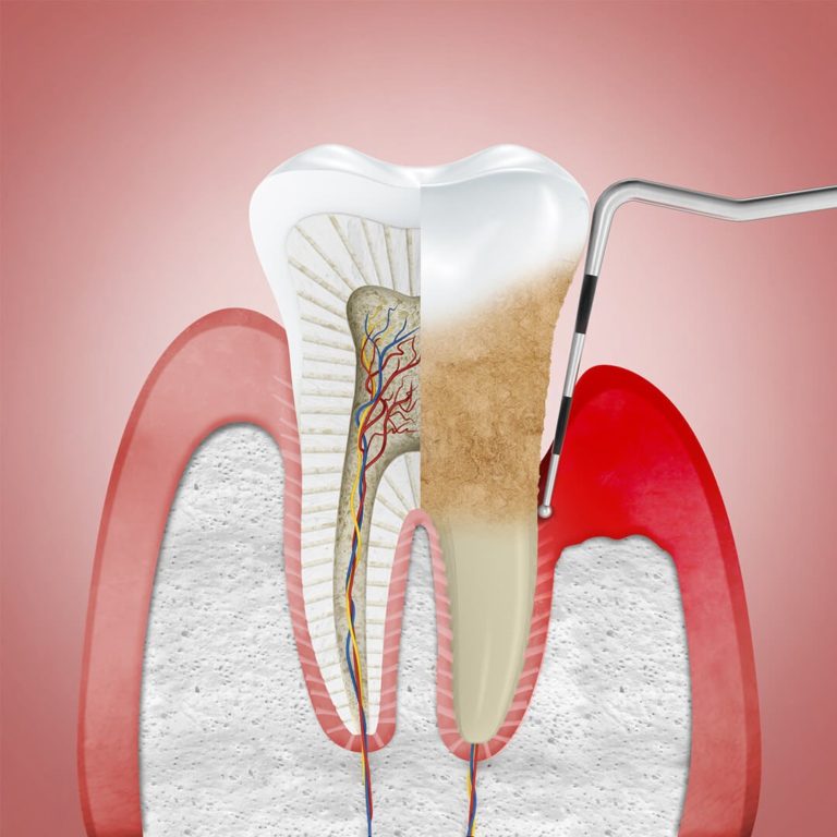 periodontitis, periodontitis treatment greece, dental tourism, gingivitis, gum disease