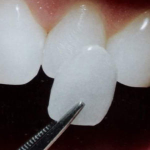 porcelain veneers, dental treatment abroad, dentist abroad, dental holidays veneers