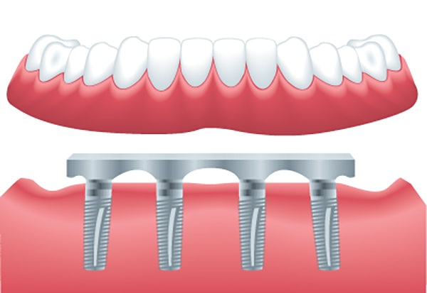 denture, dental implants, dentist greece